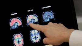 Loại thuốc đầu tiên có thể làm chậm bệnh Alzheimer