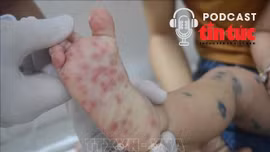 Bác sĩ ơi: Dấu hiệu nhận biết sớm bệnh tay chân miệng