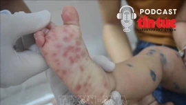 Bác sĩ ơi: Dấu hiệu nhận biết sớm bệnh tay chân miệng