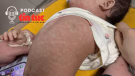 Bác sĩ ơi: Bệnh sởi dễ nhầm lẫn, dễ lây lan