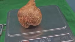 Mổ lấy thành công viên sỏi thận nặng 800 gram to nhất thế giới