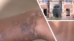 Đức đối mặt rủi ro sức khỏe cộng đồng như thế nào sau khi phát hiện ca mpox biến thể mới đầu tiên