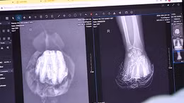 Kỳ tích tạo hình gân gấp 2 ngón chân thành ngón tay