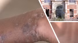 Đức đối mặt rủi ro sức khỏe cộng đồng như thế nào sau khi phát hiện ca mpox biến thể mới đầu tiên