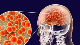 Bác sĩ ơi: Bệnh viêm não do mô cầu nguy hiểm thế nào với trẻ em?