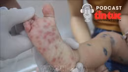 Bác sĩ ơi: Dấu hiệu nhận biết sớm bệnh tay chân miệng