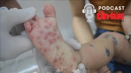 Bác sĩ ơi: Dấu hiệu nhận biết sớm bệnh tay chân miệng